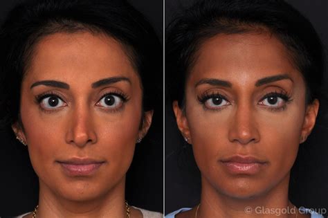 Revision Rhinoplasty | Princeton, NJ | Patient 34486