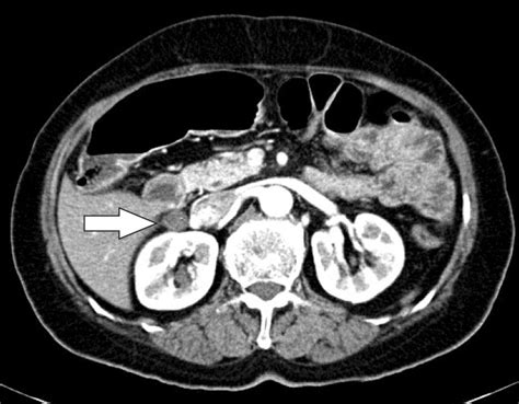 Abdomen computed tomography. Computed tomography shows a 1.6 cm-sized ...