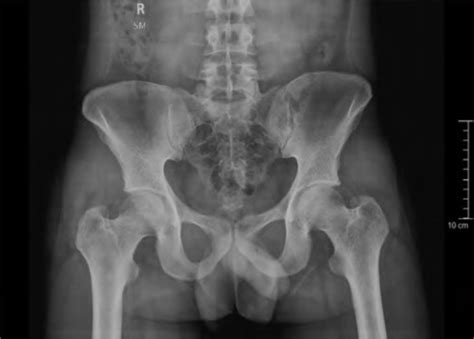 X-ray pelvis with both hip joints anteroposterior view | Open-i