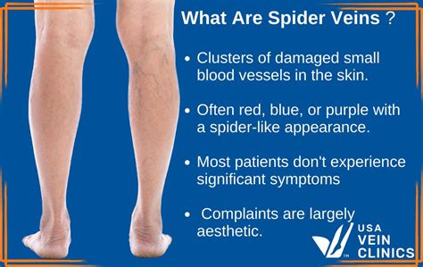 Spider Veins - What are they and how do I get them treated? - Vein, spider veins - plantecuador.com