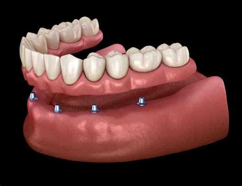 How much are full mouth dental implants - Dental News Network