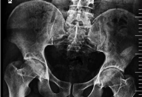 Acetabular subchondral cysts and subchondral sclerosis increase are... | Download Scientific Diagram