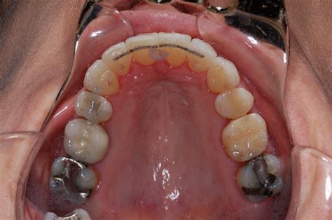 Truman Orthodontics: Narrow Smile