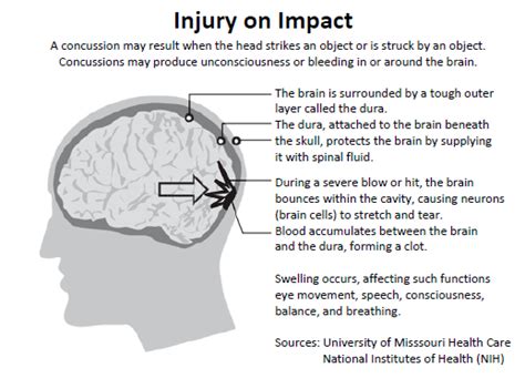 Sports Concussion Facts and Symptoms | MyBrainTest