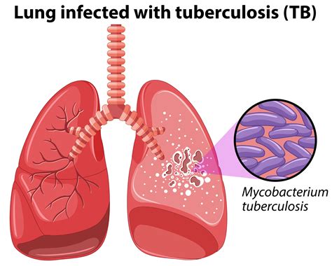 Lung infected with tuberculosis 431577 Vector Art at Vecteezy