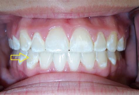 Teeth Treat: White spots on teeth after whitening