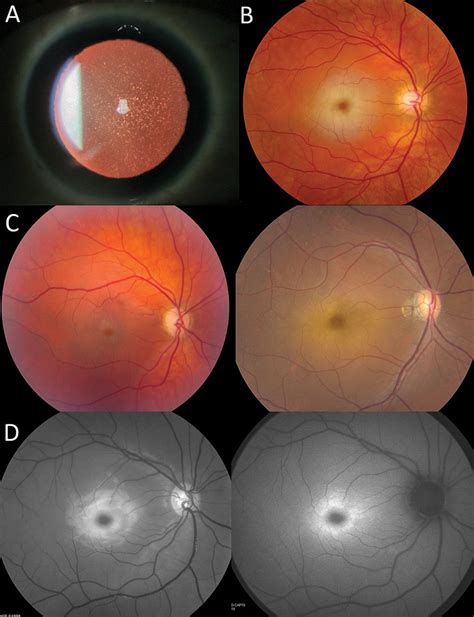 A sialidosis type I cohort and a quantitative approach to multimodal ophthalmic imaging of the ...