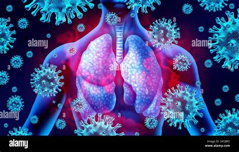 Viral pneumonia hi-res stock photography and images - Alamy