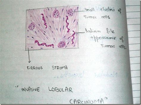 Histology Slides Database: Invasive lobular carcinoma histopathology diagram