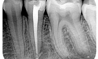 Root Canal Therapy – Oceansight Dental & Implants