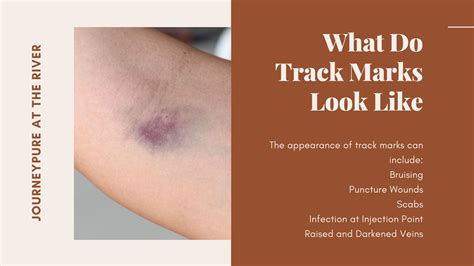 What Are Track Marks on Arms? - JourneyPure At The River