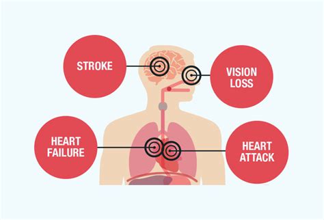 Why is Hypertension called the Silent Killer - WellaHealth