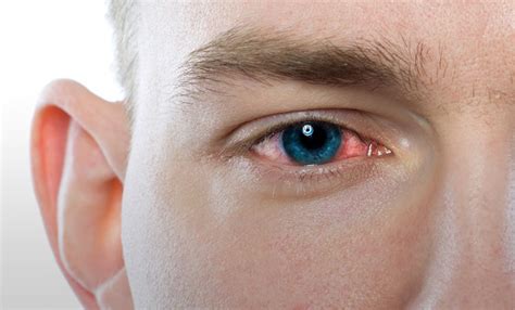 I have an eye infection … do I need antibiotics?