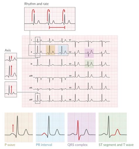 Hypokalemia Ecg Strip