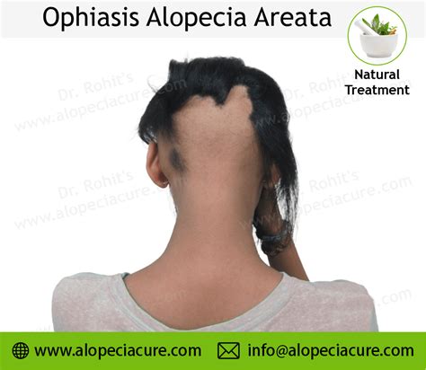 Ophiasis Alopecia Areata