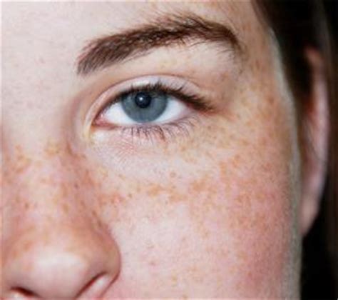 About eye freckle | General center | SteadyHealth.com