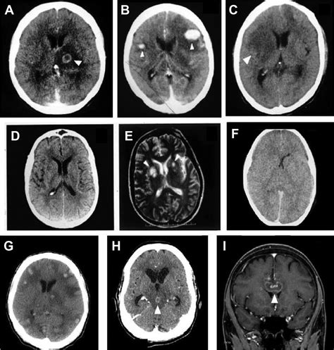 Toxoplasma Gondii Brain Abscess