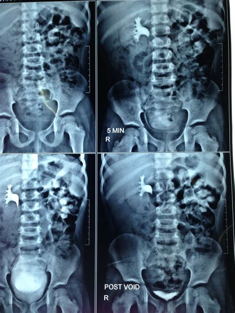 Ramayya Pramila Urology Hospital: CLEARANCE OF COMPLETE STAGHORN CALCULUS IN A SMALL CHILD WITH ...