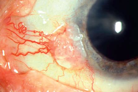 Tumors of the Conjunctiva | Ento Key