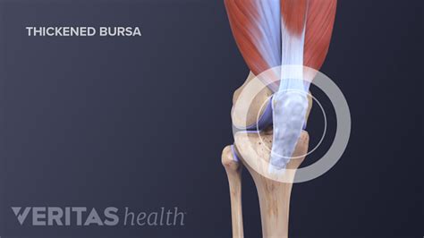 Knee (Prepatellar) Bursitis