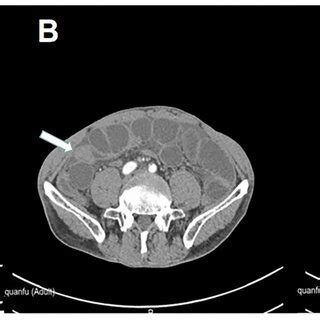 | Phytobezoar is cylindrical and hard. | Download Scientific Diagram