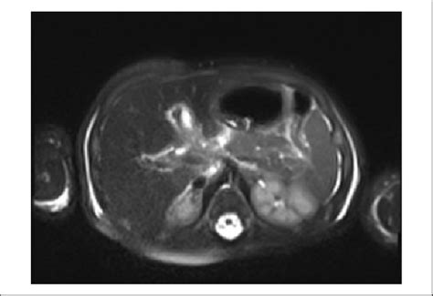 Magnetic resonance imaging of the abdomen demonstrating periportal edema. | Download Scientific ...