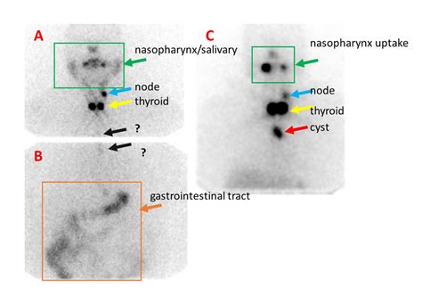 Thymic cyst causes false-positive radioactive iodine scan