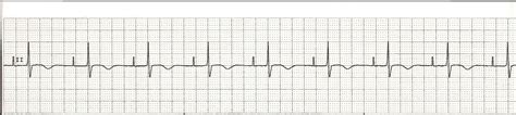 EKG Rhythm Strips 50