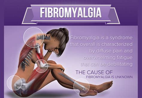 Fibromyalgia [Infographic] - Visualistan