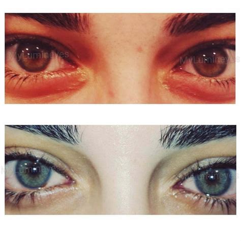 Pin by Laser Eye Color Change Surgery on laser eye color change photos | Eye color change, Laser ...