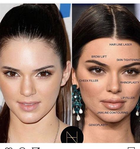 Pin by Victoria Turner on Medical spa | Facial fillers, Celebrity ...