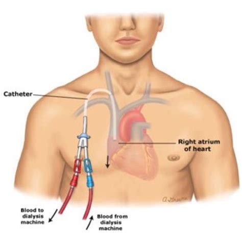 Blood Draw From Midline