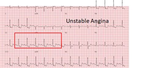 Unstable angina Flashcards | Quizlet