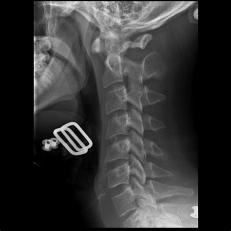 Jefferson Fracture Transverse Ligament