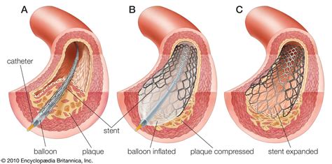 Atherosclerosis | Description, Pathophysiology, Risk Factors, & Treatment | Britannica