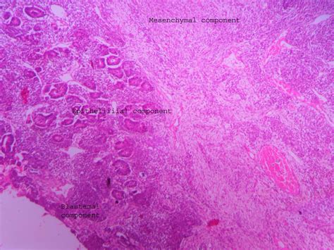 Wilm’s tumor – UG slide – Histopathology.guru