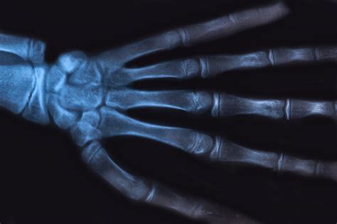 Medical x-ray image of human hand. Radiology diagnostic of skeleton ...