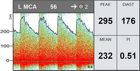 Transcranial Doppler ultrasonography in neurological surgery and neurocritical care in ...