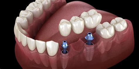 Dental Implant Treatment In Farmington, MO - Farmington Family Dental