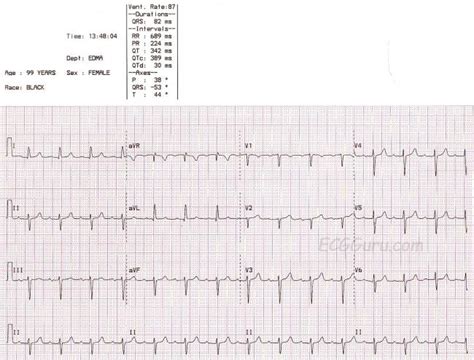 Left anterior fascicular block | ECG Guru - Instructor Resources