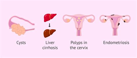 What is endometrial hyperplasia and why does it occur?