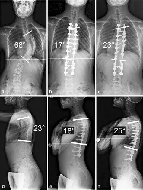 Loss of Cobb angle correction. A 10-year-old girl with Risser 0. The... | Download Scientific ...