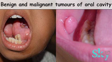 Benign and Malignant Tumours of Oral Cavity