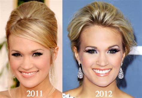 Carrie Underwood Plastic Surgery Before and After Photos - Latest ...