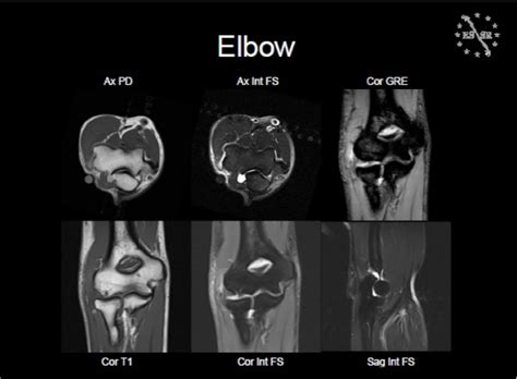 How Long Does An Elbow Mri Take : The elbow joint is a hinge joint with ...