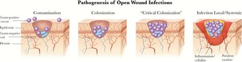 Proposed Update to the IDSA Classification of Skin and Soft Tissue Infections in Diabetes - DF Blog