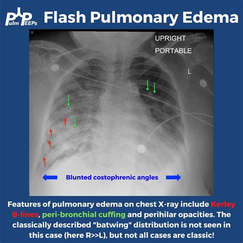 Pulmonary Edema Chf Chest X Ray - vrogue.co