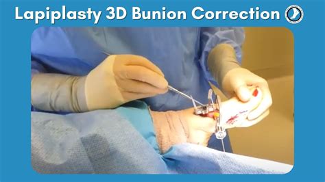 Lapiplasty Procedure - 3D Bunion Correction | Foot and Ankle Associates ...