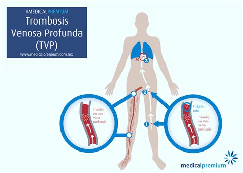 Trombosis Venosa Profunda y Embolia Pulmonar | Medical Premium