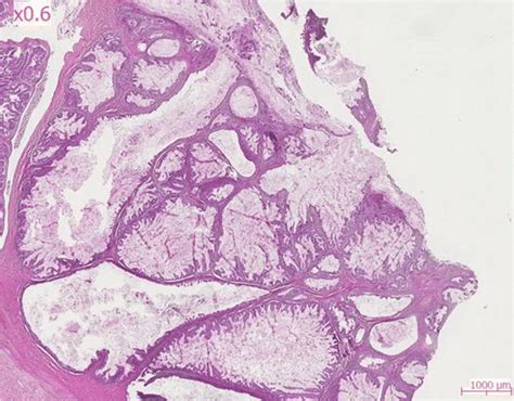 Mucinous borderline tumor. Intracystic papillae without architectural ...